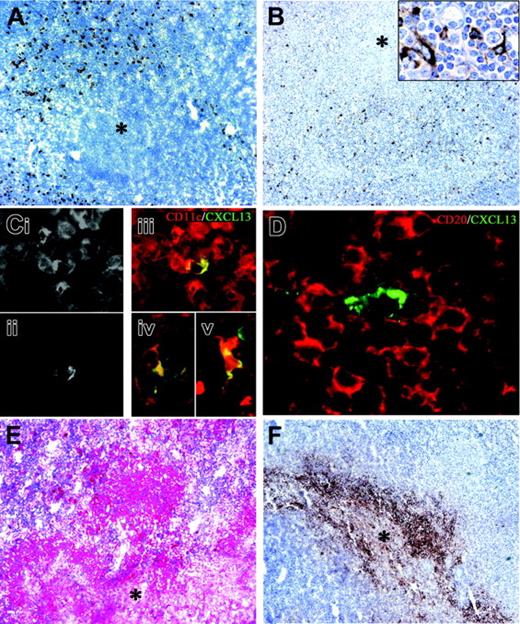 Figure 7. Dendritic cell maturation and CXCL13/IL-10 expression in B henselae–induced granuloma. In CSD granuloma the necrotic areas (*) are surrounded by numerous CD208+ mature DCs (A) and CXCL13+ cells (B); the latter population exhibits an obvious dendritic morphology (B inset). Single exposures of dual-color immunofluorescence for CD11c (Ci) and CXCL13 (Cii) and their color merging (Ciii), showing coexpression of CXCL13 and CD11c in a single cell within the granulomas; cells with an obvious dendritic morphology coexpressing CD68 and CXCL13 (Civ) and CD14 and CXCL13 (Cv) were identified within the granulomas; in panel D, a CXCL13+ cell surrounded by numerous CD20+ B lymphocytes is shown. (E-F) Anti–IL-10 and anti-CXCL8 immunoreactivity is evident in the granulomas (*, central necrotic and suppurative area). Immunoperoxidase technique for CD208 and CXCL13 counterstained with Meyer hematoxylin (A-B). Double immunofluorescence for CXCL13 (green; Cii-v and D), CD11c (red; Ci,iii), CD68 (Civ), CD14 (Cv), and CD20 (red; D). Immunoalkaline-phosphatase technique for IL-10 (E) and immunoperoxidase technique for CXCL8 (F). Original magnifications, × 100 (A-B,E-F), × 400 (B inset, Ci-v), and × 600 (D).