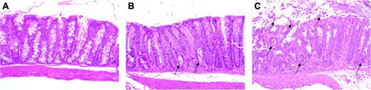Figure 3. Lethality caused by extended administration of bortezomib is attributable to gut toxicity. Lethally irradiated (1000 cGy) B6 mice underwent transplantation with TCD B10.BR BM alone or with spleen cells adjusted to yield a dose of 2 × 106 B10.BR T cells. Mice that received transplanted B10.BR T cells were treated with PBS or bortezomib (1 mg/kg twice weekly beginning on day 3). Eight days after transplantation, prior to demise, mice from each of the 3 cohorts were killed, and samples of colon tissue were analyzed for evidence of pathologic damage. Hematoxylin and eosin stains of colon tissue obtained from these mice are depicted (original magnification, 200 ×). (A) Colon tissue from a representative mouse that underwent transplantation with TCD BM only showing normal-appearing colon tissue with intact crypts lined by mucin-filled enterocytes. (B) PBS-treated mouse undergoing GVHD showing increased mitotic activity at the base of crypts associated with a few crypt abscesses (solid arrows). (C) Bortezomib-treated animal demonstrating extensive crypt destruction with sloughing of the colonic mucosa (dashed arrows), goblet cell depletion, and numerous crypt abscesses (solid arrows).