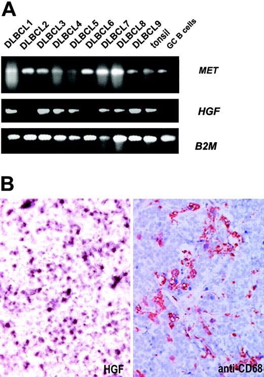 Figure 4. HGF expression in DLBCL. (A) MET-positive primary DLBCLs were analyzed for HGF mRNA expression. After RNA isolation and cDNA synthesis, RT-PCR for MET and HGF was performed. β2-Microglobulin was used as housekeeping gene control. (B) Frozen sections of DLBCL cases were analyzed for the presence of expression of HGF by mRNA in situ hybridization, using DIG-labeled antisense cRNA run-off transcripts. Serial sections were stained with anti-CD68 to identify macrophages. The section was counterstained with hematoxylin. The result shown is a representative of 8 tested DLBCL cases. Image magnification: × 200.