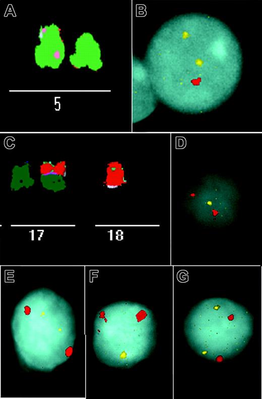 Figure 2. Examples of imbalances identified in stimulated and unstimulated CLL cells. (A) Partial M-FISH metaphase spread showing a deletion of 5p in patient 8 (Table 1). (B) An unstimulated interphase nucleus of this patient shows one signal for 5p (red) but 2 signals for 5q (yellow). (C) M-FISH identified der(17;18)(q10;q10) in patient 22 (Table 1). This rearrangement resulted in losses of 17p and 18p. (D-E) Interphase FISH was performed with 3 chromosome 17 and 18 probe sets. There was only one signal for a 17p subtelomere probe (yellow) (D), but there were 2 for 17q (yellow) (E), and in each hybridization there were 2 signals for a chromosome 17 centromere probe (red). (F-G) Similarly, we observed only one 18p subtelomere signal (yellow) (F), 2 18q signals (yellow) (G), and in each case 2 signals for 18 centromere (red). Images were obtained using a Leica DMRXA microscope (Leica, Wetzlar, Germany) with a 63 × 1.32 numeric aperture Plan Apo objective. Imaging medium was P-phenylenediamine dihydrochloride antifade solution. Images were captured using a Sensys CCD camera (Photometrics, Ottobrunn, Germany) and a Kodak KAF 1400 chip (Eastman Kodak, Rochester, NY), and were acquired using Leica Q-FISH and processed using Leica MCK software.