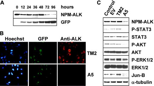 Figure 5. Lentiviral ALK shRNA abrogates NPM-ALK expression and signaling. (A) Lentivirus infection with ALK-A5 leads to an efficient down-regulation of NPM-ALK protein expression. TS cells were transduced with ALK sh-RNA lentivirus (300 μL) and then harvested to determine the NPM-ALK protein expression over time. Immunoblotting with anti-GFP antibodies was used to check the expression of the report gene within the lentiviral cassette. (B). Loss of NPM-ALK is specifically observed in cells infected with ALK-A5. TS cells were transduced with ALK-A5 or TM2 viruses, cultured for 96 hours, and then stained with anti-ALK antibody. Immune complexes were visualized using biotin-conjugated rabbit antimouse antibody followed by streptavidin-Cy3 (right panels). Nuclei were identified using Hoechst 33258 (left panels). EGFP expression is shown in middle panels. Objective magnification, 40×. (C) TS cells transduced with ALK-A5 show phospho-Stat3, phospho-AKT, and Jun B down-modulation. EV indicates empty vector.