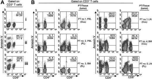 Figure 1. Binding of annexin V by T cells from patients with B-NHL. (A) Freshly isolated lymphocytes from PBL of a healthy donor were stained for binding of annexin V before (i), or, to promote apoptosis, after culture for 48 hours on immobilized anti-CD3 mAb at 10 (ii) and 100 (iii) ng/mL. (B) PBL, or involved LNs, or BM of 5 patients with FL or CLL were stained for binding of annexin V. Lymphocytes were gated on CD3+ T cells and then analyzed for CD4 or CD8 expression versus annexin V binding. Numbers in each dot plot refer to the percentage of positive cells in each quadrant. PT indicates patient.