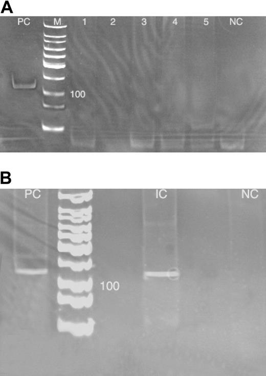 Figure 4. Touchdown enzyme time-release PCR for C psittaci in ocular adnexal EMZL tumor specimens. (A) South Florida ocular adnexal EMZL tumor specimens. PC indicates positive control (C psittaci strain 6 BC; ATCC); M, molecular ladder; lanes 1-5, 5 negative ocular adnexal EMZLs; and NC, negative control (PCR mixture with primers, but without DNA input). (B) Reanalysis of an Italian case of a C psittaci–positive ocular adnexal EMZL tumor specimen. PC indicates positive control (see panel A description for details); IC, Italian C psittaci–positive case; and NC, negative control (see panel A description for details).