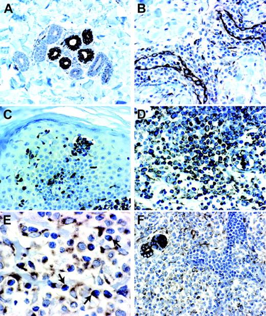 Figure 3. Immunohistochemistry for SDF-1 in normal, inflamed, and neoplastic CTCL skin biopsies. (A) Normal skin showing epithelial cells of eccrine glands with a strong SDF-1 immunoreactivity associated with membrane and cytoplasm (magnification 20×/0.40 NA). (B) Chronic dermatitis showing endothelial cells of dermal capillary vessels and scant perivascular lymphoid infiltrate with a strong SDF-1 immunoreactivity (magnification 20×/0.40 NA). (C) SS skin lesion showing a strong SDF-1 immunoreactivity associated with neoplastic T lymphocytes of pathognomonic Pautrier microabscess and neoplastic T lymphocytes that infiltrate dermis and epidermis (magnification 20×/0.40 NA). (D) MF skin lesion showing an SDF-1 immunoreactivity associated with neoplastic T lymphocytes that infiltrate dermis and epidermis (magnification × 40/0.65 NA). (E) SS skin lesion showing neoplastic T lymphocytes with an SDF-1 dotlike immunoreactivity (magnification × 60/0.80 NA). (F) SS skin lesion showing SDF-1 positivity associated with neoplastic T lymphocytes infiltrating the dermis, whereas the intravascular neoplastic T lymphocytes appear SDF-1 negative (magnification 20×/0.40 NA).