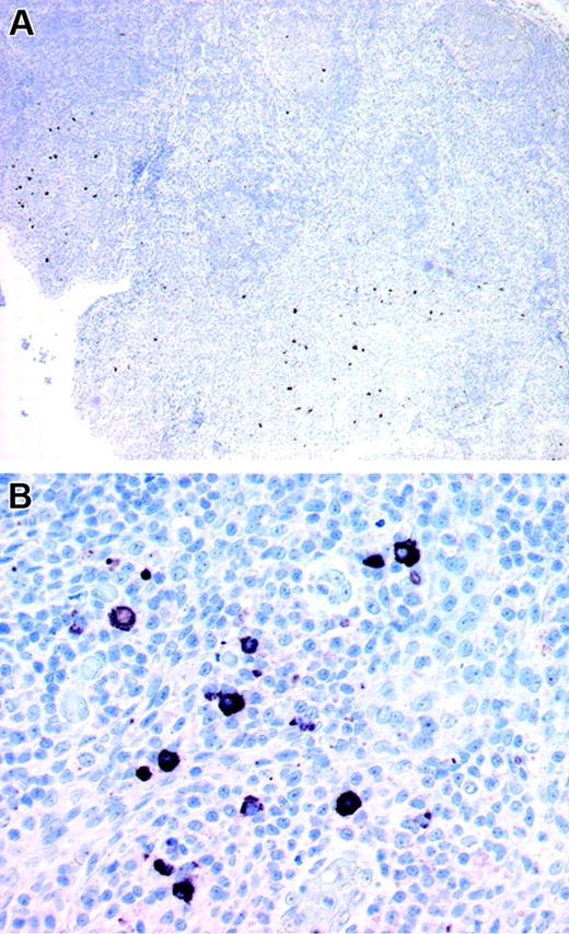Figure 1. Immunohistochemical staining of human tonsil with the patient-1 scFv. Overview (A) and detail (B) of the distribution pattern and morphology of the cells stained by the patient-1 scFv (CSA amplification system; Dakocytomation). Images were obtained with an Olympus AX70 microscope (Olympus, Tokyo, Japan) equipped with a JVC KY-F70U camera (JVC, Kyoto, Japan) using Diskus v4.28 software (Hilgers, Königswinter, Germany). Images were captured with (A) a 4 ×/0.16 NA objective (total magnification, × 6.4) and (B) a 20 ×/0.7 NA objective (total magnification, × 140).