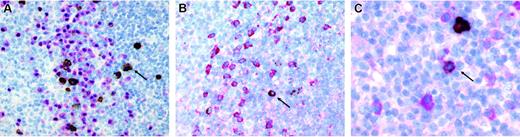 Figure 2:. Immunohistochemical double stainings of human tonsil with the patient-1 scFv. Double stainings with the patient-1 scFv (brown) and antibodies against (A) the plasma cell–specific transcription factor IRF4 (red), (B) the immunoglobulin subclass G (red), and (C) the immunoglobulin subclass A (red). Arrows denote double-stained cells. Images were obtained with an Olympus AX70 microscope equipped with a JVC KY-F70U camera using Diskus v4.28 software. Objectives used were as follows: panels A and B, 20 ×/0.7 NA (total magnification, × 140); panel C, 40 ×/0.95 NA (total magnification, × 380).