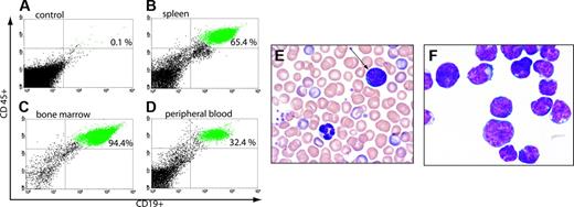 Figure 2. Establishment of xenografts. NOD/SCID mice were irradiated with 275 cGY and were injected with 107 lymphoblasts obtained from patients with pre-B ALL. Xenografts were established from 78% of patient samples used as assessed by flow cytometry for ALL. Top panel shows flow cytometric analysis of CD45 and CD19 staining of peripheral blood from a control mouse (A, 0.1%) and a xenografted mouse (D, 32%). Splenocytes from this mouse were 65% human ALL (B), and bone marrow was 94% human ALL (C). The majority of xenografted animals had more than 90% replacement of bone marrow and more than 60% replacement of spleen with human ALL. Also pictured are photomicrographs of Wright-Giemsa-stained peripheral blood (E) with human lymphoblast (arrow) and murine granulocyte (shown) and a cytospin prepared from bone marrow nucleated cells showing a monomorphic population of lymphoblasts (F). Images were captured using a Zeiss Axiovert 40C light microscope (Carl Zeiss, Thornwood, NJ) equipped with an apochromatic 40 ×/0.60 NA objective lens and a Nikon 995 camera (Nikon, Melville, NY).