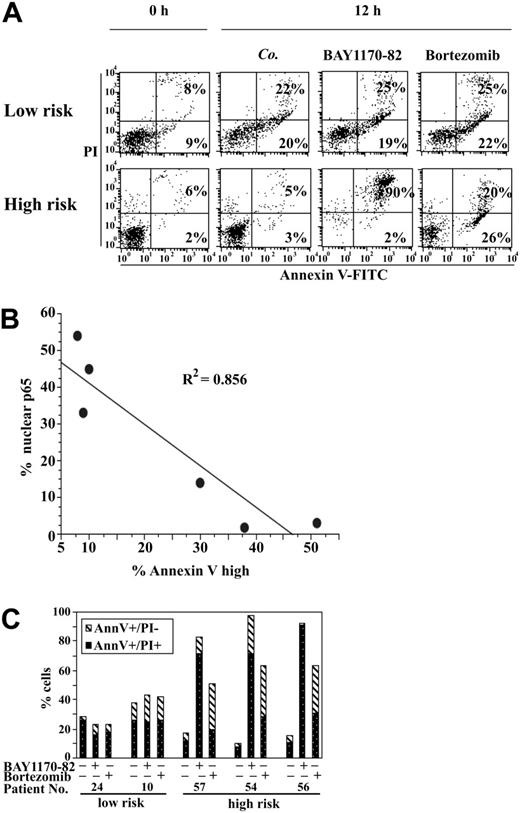Figure 7. Ex vivo killing of bone marrow cells from MDS patients by BAY11-7082 or bortezomib. Representative fluorescence-activated cell sorter (FACS) pictograms as obtained for CD34+ cells from patients 24 with low-risk MDS and 54 with high-risk MDS (A) (Table 1) 12 hours after culture in the presence or absence of BAY11-7082 or bortezomib. The numbers in each quadrant indicate the percentage of cells exhibiting the indicated changes. (B) Inverse correlation between p65 translocation and spontaneous apoptosis upon overnight in vitro culture of CD34+ cells from different MDS patients. Each point represents 1 patient. The correlation coefficient was determined by linear regression. (C) Statistical comparison of low- and high-risk patients treated and evaluated as in panel A. Note that BAY11-7082 or bortezomib only enhanced the rate of spontaneous apoptosis in high-risk but not in low-risk MDS.