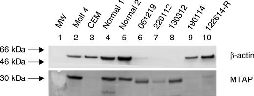 Figure 5. Expression of MTAP in primary T-ALL and PBMCs from a healthy donor. Protein was extracted and subjected to Western blot analysis as described in “Materials and methods.” Membrane blots were probed with an MTAP antibody followed by an alkaline phosphatase-conjugated antimouse secondary antibody. Membranes were also probed with a β-actin antibody as a control for protein loading. Proteins were visualized using a STORM 840 Phoshorimager. Protein from MOLT-4 and CEM cell lines were used as a positive and negative control, respectively. MW indicates molecular weight standards.