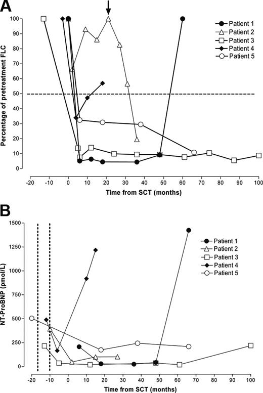 Figure 1. Serial serum FLC and NT-ProBNP concentration. Each line represents a single patient. Open symbols represent patients alive at censor; filled symbols, patients who had died. (A) Response of the FLC concentration to chemotherapy. FLC concentration decreased after SCT to less than 50% of pretreatment levels in 4 patients. Patient 3 experienced a decrease in FLC concentration after heart transplantation and before SCT that was further consolidated by SCT. Patient 2 had a poor initial FLC response to SCT and then had a relapse but responded to high-dose dexamethasone therapy (arrow). Patients 1 and 4 experienced FLC relapse associated with progressive intracardiac and extracardiac amyloid accumulation and died. (B) Serial serum NT-proBNP concentration decreased after heart transplantation (timing indicated between the dotted vertical lines) in the 4 patients in whom it was measured. Relapse of the plasma cell dyscrasia and accumulation of amyloid in the cardiac allograft and major viscera in 2 patients were associated with a marked increase in NT-ProBNP concentration and patient death.