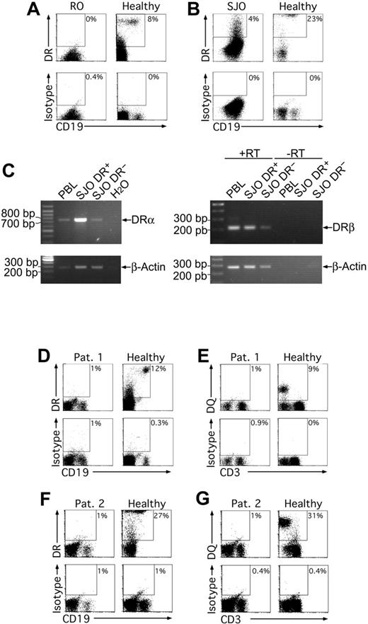 Figure 7. Residual MHCII expression in human MHCII deficiency. The RFX5-deficient human B-cell lines RO (A) and SJO (B) were cultured overnight with 10 μg/mL LPS, stained for CD19 and HLA-DR, and analyzed by flow cytometry. PBLs were used as healthy control cells. Only live cells are shown in all cases. RT-PCR analysis of HLA-DR expression by SJO cells (C). The cells were FACS sorted into HLA-DR+ and HLA-DR- fractions. Cells (105) were used for RT-PCR with primers for HLA-DRα and β. Primers were placed into highly homologous regions according to aligned HLA-DR alleles at the IMGT HLA database.56 The α-chain PCR was intron spanning, the β-chain PCR was not. For the latter control, reactions lacking reverse transcriptase (RT) were included. PBLs (105) from a healthy donor were used as positive controls. A PCR for β-actin served as control for the RT reaction. (D-G) MHCII expression on PBLs derived from 2 patients previously diagnosed to be MHCII deficient was analyzed after overnight culture in the presence of 10 μg/mL LPS and 0.5 μM CpG 2006 (patient 1) or 10 μg/mL LPS (patient 2). The patients were 1 year (F-G) and 4 years (D-E) of age, and the molecular defects were located in the RFX-ANK gene. After culture, the cells were stained for CD19 and HLA-DR (D,F) or CD3 and HLA-DQ (E,G) or CD3 and HLA-DP (data not shown) and analyzed by flow cytometry. Antibodies of irrelevant specificities were used as isotype controls for the HLA-DQ, HLA-DR, and HLA-DP stainings. Dot plots show cells in lymphocyte- and live-cell gates. In all experiments, similar results were obtained without treatment or treatment with 0.5 μM CpG, 50 μg/mL pI/pC, or CD40L.