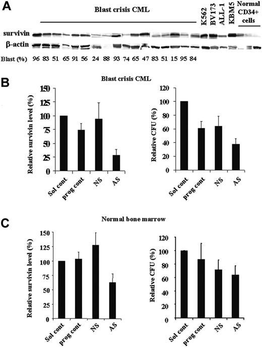 Figure 8. Decreases of BFUs of bone marrow blasts from BC CML patient samples by survivin down-regulation. Expression of survivin in bone marrow samples of blast crisis CML, Ph+ cell lines, and normal CD34+ cells by Western blot (A). Survivin expression (48 hours) by Western blot and CFUs of CML bone marrow (n = 5) (B) and normal bone marrow (n = 3) (C) treated with Sur-AS-ODN. Sol cont indicates solution T control; prog cont, nucleofection program K17 control; NS, Sur-NS-ODN control; AS, Sur-AS-ODN.