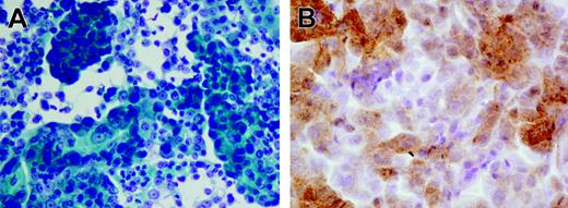 Figure 1. Pathologic analysis of the prostate cell line generated from patient no. 18. (A) Highly differentiated adenocarcinoma cells; Papanicolau staining. (B) Anti-PSA staining. Images were acquired with a BX51 microscope (Olympus, Tokyo, Japan) with a 600×/0.80 NA objective, a DP70 digital camera (Olympus), and Olympus DP70 Windows XP–compatible acquisition software.