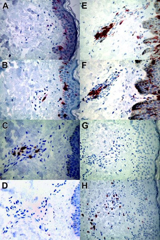 Figure 1. Representative local responses to the autologous combination vaccine in punch biopsy specimens from the injection site. (A-D) Control tissues from healthy volunteers. (A) CD1a (O10 staining). (B) Dendritic cells (S-100 staining). (C) CD4 (CD45RO/OPD4 staining). (D) CD8 (CD45RO/C8/144B staining). (E-H) Representative tissues from patients. (E) Abundant dermal perivascular infiltration of Langerhans cells (O10 staining) with (F) retention of dendritic-cell infiltrate in patient 5 (S-100 staining). (G) Paucity of CD4+ lymphocytes (CD45RO/OPD4 staining) with (H) moderate infiltration of CD8+ lymphocytes in patient 2 (CD45RO/C8/144B staining). These studies were performed on all patients. For all panels, original magnification is × 20. Images were visualized using a Nikon Labophot-2 microscope equipped with a 20×/1.0 Plan objective lens (Nikon, Tokyo, Japan). A Spot Insight QE 4.2 camera (Diagnostic Instruments, Sterling Heights, MI) was used to capture images, and Adobe Photoshop Elements 2.0 software (Adobe Systems, San Jose, CA) was used to process them.