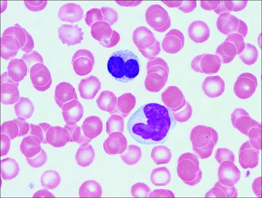 Figure 1. Adult T-cell leukemia/lymphoma. Peripheral blood illustrates 2 lymphoma cells. One displays a lobated nucleus with clumped chromatin; the other is larger with more dispersed chromatin and a cerebriform-shaped nucleus.