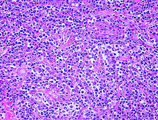 Figure 2. Angioimmunoblastic T-cell lymphoma. Many small vessels (high endothelial venules), histiocytes, scattered eosinophils, and plasma cells are admixed with the tumor cells that display clear cytoplasm.