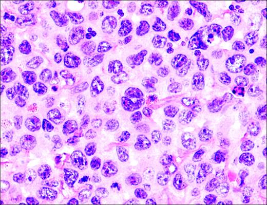 Figure 3. Anaplastic large-cell lymphoma. Infiltrate is composed of large transformed lymphocytes, including hallmark cells with kidney-shaped nuclei.