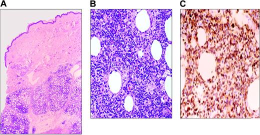 Figure 4. Subcutaneous panniculitis-like T-cell lymphoma. (A) Infiltrate involves the subcutaneous tissues and spares the dermis and epidermis. (B) Lymphoma cells are variably sized, ranging from small to large cells with pleomorphic, hyperchromatic nuclei. (C) CD3 immunohistochemical stain highlights the tumor cells, including those rimming individual fat cells.