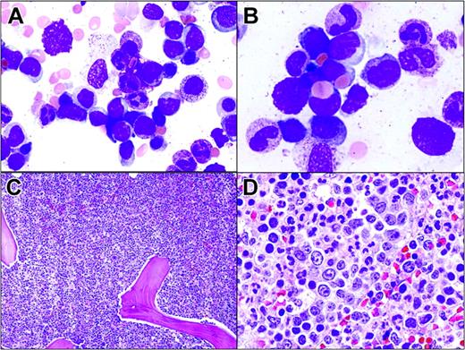 Figure 5. Hepatosplenic T-cell lymphoma involving the bone marrow. (A) Tumor cells in the bone marrow aspirate resemble blasts. They are medium-sized with dispersed chromatin and scant cytoplasm. (B) Two lymphoma cells display erythrophagocytosis. (C) Hypercellular bone marrow with almost all normal hematopoietic cells replaced by lymphoma cells growing in sheets. (D) Lymphoma cells located within the lumen of a sinus.