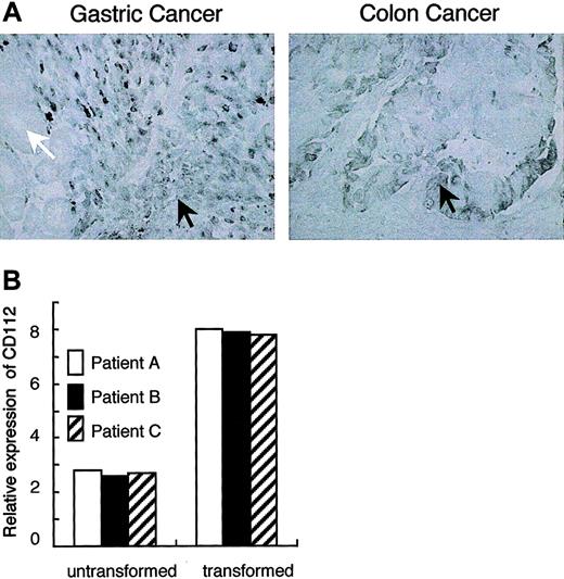 Figure 1. Up-regulation of CD112 expression in gastric and colon cancers. (A) Specimens from human gastric and colon cancer tissues were stained with anti-CD112 mAb (TX31). Positive signals were observed in the poorly differentiated (black arrow), but not well-differentiated (white arrow), transformed epithelial cells in gastric cancer (left). The transformed epithelial cells also show the highly positive signal (black arrow) in colon cancer (right). (B) mRNA was obtained from gastric cancer tissues from 3 patients with poorly differentiated histologic type. In each patient, mRNA was also obtained from untransformed normal tissue area. RT-PCR was performed with Cd112-specific primers and the amount of cDNA was measured by quantitative PCR analysis. CD112 mRNA expression was normalized to the internal standard 18S ribosomal RNA.