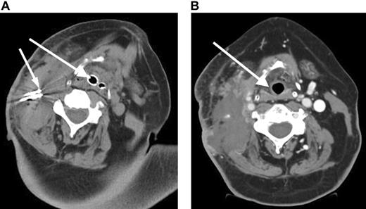 Figure 1. Rapidly enlarging large B-cell lymphoma neck mass causing airway obstruction. (A) Pre-RF ablation CT scan shows a large right cervical mass with extensive tracheal deviation with compressed airway expanded by endotracheal tube (large arrow) and RF ablation needles (small arrow) within cervical mass. (B) Post-RF ablation CT demonstrates a devascularization and reduction in cervical mass and improvement of tracheal deviation with shift of trachea (arrow) to midline.