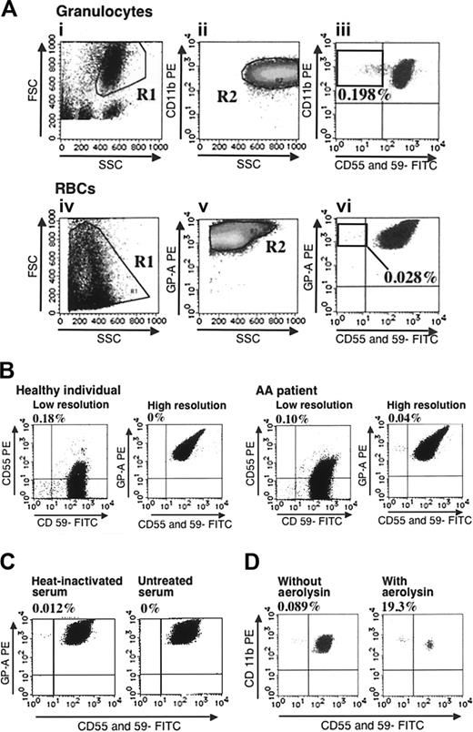 Figure 1. Validity of high-resolution flow cytometry. (A) An example of analysis on a patient with PNH+ AA is shown. Gates were set up to exclude SSCdim (i) and CD11bdim granulocytes and glycophorin Adim RBCs (ii,v). Cells within rectangles showing horizontal distribution represent PNH-type cells. (B) RBCs from a healthy individual and a patient with AA were examined using a low-resolution assay and the high-resolution assay. Numbers on histograms denote the percentages of CD55-CD59- cells in total RBCs for the low-resolution assay, and in glycophorin A+ RBCs for the high-resolution assay. (C) RBCs from a patient with PNH+ AA were incubated in acidified saline containing heat-inactivated or untreated serum. CD55-CD59- RBCs were then quantified. (D) PNH+ AA WBCs were incubated with or without 0.5 × 10-8 M aerolysin and analyzed by flow cytometry.