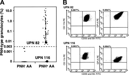 Figure 2. Proportions of PNH-type granulocytes. (A) Proportions of CD55-CD59- granulocytes in each patient. (B) Histograms from one patient with PNH+ (UPN 82) with minimal PNH-type cells and from another patient with increased PNH-type cells only in RBCs (UPN 116).