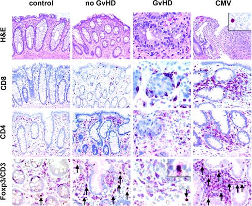 Figure 2. Histology and immunohistochemistry for CD4+, CD8+, and CD3+FOXP3+ T cells of representative colonic biopsies from healthy controls and patients with no GvHD, with GvHD after bone marrow transplantation, and with CMV infection. A normal amount of CD3+ T cells (red, membranous) with very few regulatory T cells coexpressing FOXP3 (brown, nuclear) is found in healthy controls, whereas mucosal biopsies of patients without GvHD display a high number of CD3+FOXP3+ T cells in the lamina propria (arrows, bottom row) as opposed to a low number of regulatory T cells in patients with GvHD. All FOXP3+ cells in addition expressed CD25 (inset/bottom row). The number of CD8+ T cells is increased in biopsies from patients with GvHD especially in and around crypts displaying many characteristic apoptotic bodies. In CMV infection (inset/upper panel: nuclear staining for CMV antigen), the number of CD3+FOXP3+ regulatory T cells is also elevated compared with patients with GvHD. Original magnifications, × 200; and × 600 (inset). Microscope: Olympus AX70 (Olympus, Melville, NY); numeric aperture of objective lenses: × 20, 0.70 mm; × 60, 1.40. Stains: hematoxylin and eosin (H&E; top row); APAAP and immunoperoxide. Camera: JVC KY-F70 (JVC, Yokohama, Japan); acquisition software: DISKUS (Koenigswinter, Germany); and software used for image processing: Adobe Photoshop 7.0 (Adobe Systems, San Jose, CA).