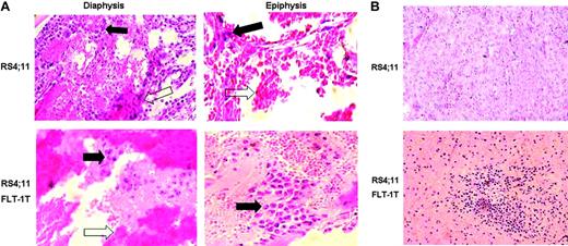 Figure 3. FLT-1-transfected ALL cells show different in vivo phenotype. Native RS4;11 cells or those transfected with full-length FLT-1 were inoculated into sublethally irradiated NOD-SCID mice, as described in “Materials and methods.” (A) Results show the transfected cells (bottom) formed masses of leukemia cells in the epiphysis (here shown at × 400 magnification) of the long bones, 3 to 5 days after inoculation, whereas the untransfected cell line localized predominantly in the diaphysis (top, × 200 magnification). Black arrows indicate leukemia cells in the different areas of the BM of long bones; white arrows, evidence for blood leakage in the bones of inoculated recipients. Results shown are representative of 3 mice per condition. (B) Evidence for the earlier appearance of extramedullary disease in mice inoculated with FLT-1-transfected RS4;11 cells. Bottom panel shows a spleen section (× 200 magnification) of a NOD-SCID recipient 10 days after RS4;11 FLT-1T cells inoculation, clearly evidencing the engraftment of leukemia cells. The results are representative of 3 independent animals. Images were visualized through a 40 ×/0.65 PLAN objective lens, captured with a Sony Cybershot DSC-560 digital camera (Sony, Lisbon, Portugal), and processed with Adobe Photoshop software (Adobe Systems, San Jose, CA).