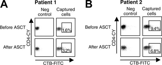 Figure 4. Differences in mRNA expression in peptide-specific T cells before and after ASCT. (A) PBMCs of a DR4 heterozygotic patient, from time points before (full-blown disease) and 2 year after ASCT (complete remission) and (B) from a DR4 heterozygotic patient, from time points 5 years after ASCT (patient still in remission) and 7 years after ASCT (complete relapse of disease) were stimulated with a peptide derived of human hsp60. After 4 days, peptide-specific CD4+ T cells were captured and sorted, using the indicated gates. CTB-FITC and CD4-CY were used to visualize CD4+ T cells bound by the aAPCs. Liposomes containing complete rafts but no MHC-peptide complexes were used as negative controls. The sorted peptide-specific CD4+ T cells were lysed and analyzed on the mRNA expression of the transcription factors T-bet and GATA-3 and the cytokines IL-10 and IFN-γ by quantitative PCR.