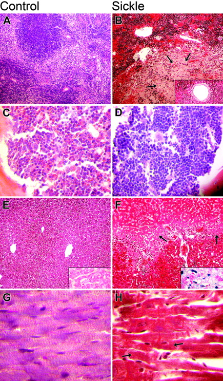 Figure 1. Comparison of histopathology in control and sickle mice. The columns show microscopic findings in control (A, C, E, G) and sickle (B, D, F, H) mice. The 4 rows (top to bottom) show findings in the spleen (A, B), bone marrow (C, D), liver (E, F), and heart (G, H). (A, B) Sickle mice had severe splenic sinusoidal congestion by sickle erythrocytes, increased hematopoietic cells, infarcts (arrows), and vascular ectasia (inset) (H&E original magnification, 100 ×; inset, 400 ×). (C, D) Erythroid hyperplasia was more severe in the bone marrow of sickle mice (H&E original magnification, 100 ×). (E, F) Hepatic findings in sickle mice included more sinusoidal congestion, infarct, and siderosis (inset) (H&E original magnification, 100 ×; insets iron stain, 400 ×). (G, H) Cardiac findings in sickle mice included infarcts, which, when acute, appeared as loss of normal striations (arrows).