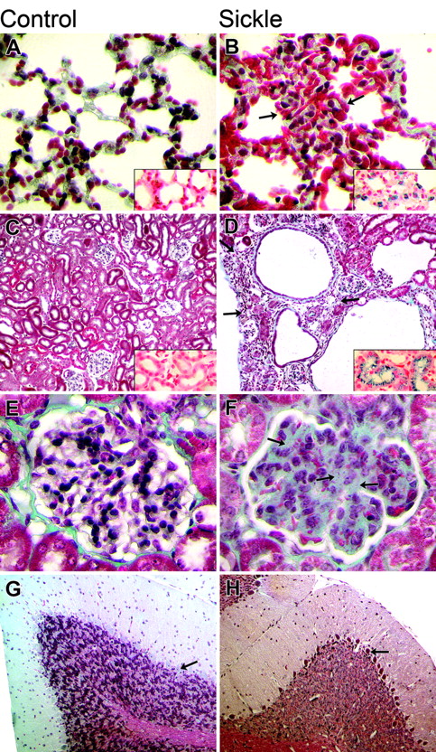 Figure 2. Comparison of histopathology in control and sickle mice. The columns show microscopic findings in control (A, C, E, G) and sickle (B, D, F, H) mice. The 4 rows (top to bottom) show findings in the lung (A, B), kidney (C, D), glomerulus (E, F), and cerebellum (G, H). (A, B) Pulmonary findings in the sickle mice included more severe vascular congestion (arrows) and siderosis (inset) (H&E original magnification, 100 ×; inset iron stain, 100 ×). (C, D) Renal findings included infarcts (arrows) and siderosis (inset) in the sickle mice (Trichrome stain original magnification, 100 ×; inset iron stain, 100 ×). (E, F) Glomerular changes in the sickle mice included mesangial hyperplasia (arrows). (Trichrome stain original magnification, 400 ×). (G, H) Cerebellar findings included pyknotic Purkinje cell in the sickle mice (arrows) (Trichrome stain original magnification, 100 ×).