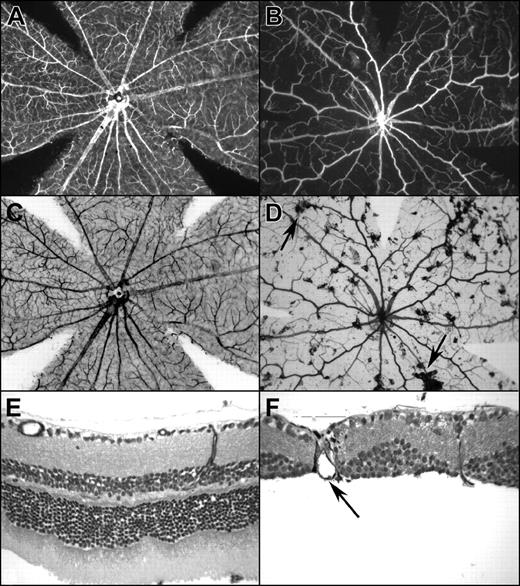 Figure 4. Retinas from 1-year-old Berkeley SS mice that were heterozygous or homozygous for the rd1 mutation. (A, C, E) Heterozygous for the rd1 mutation; (B, D, F) homozygous for the rd1 mutation. Retinas were incubated for enzyme histochemical demonstration of ADPase activity and then flat-embedded in JB-4. The ADPase activity in viable blood vessels appears white with dark-field illumination (A, B) and black with bright-field illumination (C, D). (A) The normal mouse retina has a spoke wheel pattern of blood vessels that emanates from the optic nerve head (center). (B) The Berkeley mouse that was homozygous for rd1 had a much attenuated retinal vasculature and was missing the dense, deep capillary system. (C) There was no pigment present in the retina of the mouse heterozygous for rd1 with bright-field illumination. (D) The Berkeley rd1/rd1 mouse had many areas that were pigmented, suggesting that the retinal pigment epithelial (RPE) cells had migrated into the sensory retina (arrow). (E) When the normal-appearing retina in panels A and C was sectioned, the 2 nuclear layers of retina were apparent, and photoreceptor outer segments were present below the outer nuclear layer (bottom). The retinal vasculature in the inner retina appeared normal, and a vessel is seen connecting the superficial and deep capillary systems of the retina in this field. (F) The Berkeley rd1/rd1 mouse had no outer nuclear layer or photoreceptor outer or inner segments (bottom), a disorganized inner nuclear layer (bottom), and RPE cells (arrow) had migrated into the retina and ensheathed a dilated blood vessel.
