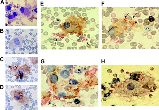 Figure 6. Hemophagocytosis by CD11c+ cells in bone marrow cells from patients with hemophagocytic syndrome. Bone marrow smear preparations from patients with hemophagocytic syndrome were stained with May-Grünwald-Giemsa staining (patient 1) (A), CD83 staining (patient 1) (B), CD86 staining (patient 1) (C), mannose receptor staining (patient 1) (D), or CD11c (brown)/CD61 (red) double staining for patient 1 (E), patient 2 (F-G), and patient 3 (H). The arrows indicate CD61+ platelets or substrates.