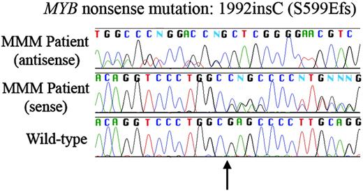 Figure 1. Frameshifting point mutation in MYB gene in granulocytic DNA from a patient with myelofibrosis with myeloid metaplasia. Insertion of a cytosine base (arrow; c.1992insC and p.S599EfsX605; GenBank reference sequences NM_005375 and NP_005366, respectively) leads to a frameshift with premature stop codon generation. This was the only nonsynonymous point mutation detected in analysis of MYB gene (25 patients) and EP300 KIX domain. Bottom: wild-type; middle: patient sense sequence; top: patient antisense sequence. Patient sequences demonstrate confused sequence expected for mixed clonality insertional mutation.