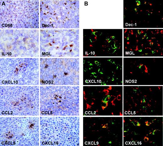 Figure 3. Immunohistochemical and microscopy evaluation of frozen tumor sections. (A) Immunohistochemical evaluation of frozen tumor sections. The micrograph shows the following: high number of macrophages (brown cytoplasm staining to monoclonal CD68 antibody) infiltrating neoplastic tissue; monoclonal antibody to mouse Dectin-1 identifies a high number of small immunopositive cells (cells with brown cytoplasm) intermingled with neoplastic elements; immunohistochemistry with monoclonal antibodies to mouse interleukin-10, mMGL1, CXCL16, and NOS2 identifies isolated positive elements (brown cells); immunohistochemistry with biotinylated anti-mouse CRG-2/IP10 antibody (CXCL10) shows a cluster of positive small cells, whereas isolated elements are not observed; immunohistochemistry to CCL2, CCL5, and CXCL9 shows similar patterns with clusters of positive brown cells and few isolated positive cells. Original magnifications: × 20 (CD68, Dectin-1, CXCL10), × 40 (IL-10, mMGL1, NOS2, CCL2, CCL5, CXCL9, CXCL16). (B) Laser scanning confocal microscopy evaluation of frozen tumor sections: double immunostaining with monoclonal antibodies to mouse CD68 (red) and Dectin-1, IL-10, CRG2/IP10/CXCL10, mMGL1, NOS2, CCL2, CCL5, CXCL9, CXCL16 (all green staining). As shown in the micrographs, Dectin-1, IL-10, CRG-2/IP10, mMGL1, CCL2, CCL5, CXCL9, CXCL16 are expressed in macrophages but not in the totality of the CD68+ elements (red staining); NOS2-CD68 colocalization is observed in very rare cells.