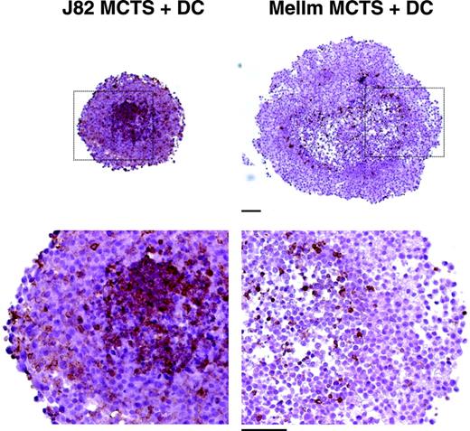 Figure 1. Infiltration of monocytes into multicellular spheroids of J82 and MelIm. MCTSs were generated using 5 × 103 suspended cells from exponentially growing tumor cell monolayers and cultured on 1% solid agarose in 96-well plates. After 4 to 5 days, half of the medium was replaced by a monocyte suspension containing 4 × 104 monocytes. MCTS cocultures were harvested 1 day later. Images show 5-μm paraffin sections stained for the leukocyte marker CD45 using a routine peroxidase technique with DAB as chromogen and hematoxylin counterstain to visualize infiltrated monocytes (bar = 100 μm).
