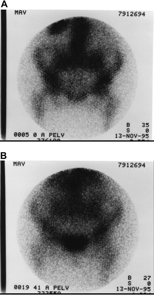 Figure 1. 131I–anti-CD45 antibody localization. Anterior images of pelvis demonstrating localization of 131I-BC8 antibody in a patient with AML in remission 0 hours (A) and 41 hours (B) after infusion of trace-labeled antibody.