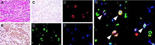 Figure 4. Infiltration of DP macrophages at the site of myocarditis. Myocarditis was induced in FW-wt rats by immunization with porcine myosin and the adjuvant containing killed tuberculosis germs at 3 weeks of age. Three weeks later, the heart was extirpated and used for histologic and immunocytochemical examinations. Experiments were repeated twice. Representative results are shown. (A) Hematoxylin and eosin staining. (B-C) Immunohistochemical staining for CD68 (ED-1) and CD3 (IF4), respectively. The cardiac tissues were cut into small pieces and digested with 0.16% collagenase type II. After removal of tissue fragments, cell suspension was incubated in a plastic dish at 37°C. One hour later, adherent cells were harvested and immunofluorescent triple staining was done for CD68 (ED-1, green; D), CD4 (OX-35, red; E), and CD8 (OX-8, blue; F). (G) The merged image. Arrowheads indicate DP macrophages also stained for CD68. Total magnification: × 40 (A-C), × 80 (D-F), and × 200 (G).