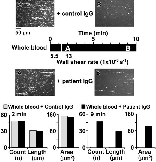 Figure 4. Effect of IgG from a patient with TTP on VWF-mediated and activation-independent platelet thrombus formation under flow. Whole blood containing 93 μM PPACK as anticoagulant and 10 μM PG E1 to inhibit platelet activation was supplemented with 2 mg/mL IgG purified from the plasma of a healthy individual (control IgG) or 2 mg/mL IgG purified from the plasma of a patient with function-blocking antibodies against ADAMTS13 (patient IgG) and then perfused over immobilized VWF. The images shown are single frames from a real-time recording. The timeline (black horizontal bar) shows at what moment during the experiment a given image was taken as well as the wall shear rate during different periods of perfusion, as explained in the Figure 1 legend (A, 120 seconds, 13 000 s-1; B, 540 seconds, 13 000 s-1). The bar graph shows the average count, length, and area of all the platelet aggregates present in a field of view after 2 and 9 minutes of perfusion in the presence of control or patient IgG, as indicated.