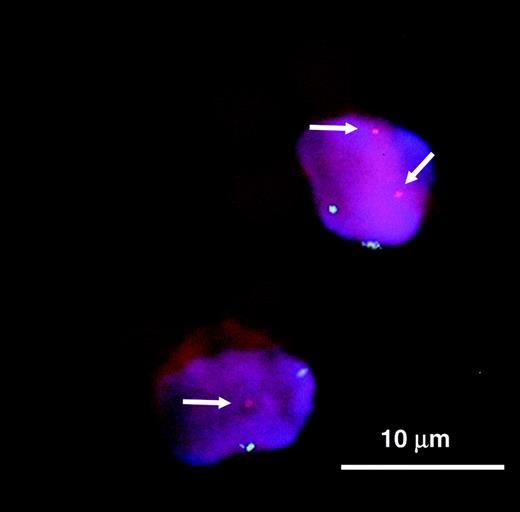 Figure 2. FISH analysis of CECs in patients with MM. Multicolour FISH analysis of immunomagnetically sorted CECs by means of Dynabeads shows 1 CEC (bottom left) with a 13q14 deletion (1 red signal, bottom left arrow) and a normal diploid copy number of chromosome 10 (2 green signals), and 1 cytogenetically normal CEC (top right) with 2 red (top 2 arrows) and 2 green signals. In patients with MM, most CECs are EPCs because they express CD133, a marker gradually lost during EC differentiation (positive red staining for PE-conjugated murine anti-CD133 monoclonal antibody). Note that several Dynabeads are attached to the cells. Scale bar equals 10 μm.