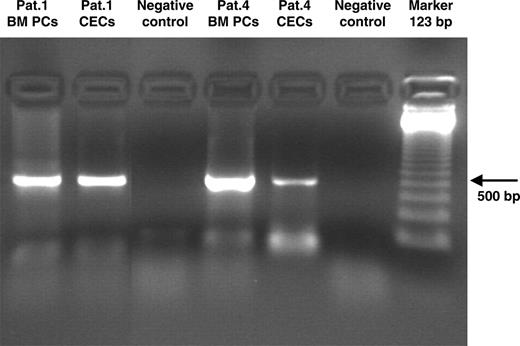 Figure 3. Immunoglobulin gene rearrangements in immunomagnetically sorted CECs in MM patients with 13q14 deletion. PCR analysis demonstrated that in MM CECs, immunoglobulin genes were clonally rearranged. Sequence analysis showed that MM CECs carried the same immunoglobulin rearrangement as bone marrow plasma cells (Patient 1: VH3-11, D1-26, JH6; Patient 4: VH2-5, D3-3, JH4) BM PCs indicate bone marrow plasma cells.