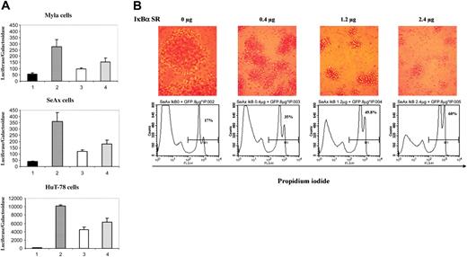Figure 2. Transfection of the super-repressor in CTCL lines inhibits NF-κB activation and induces apoptosis. (A) Dose-dependent inhibition of NF-κB transcriptional activation in CTCL cell lines. CTCL cell lines (MyLa, SeAx, and HuT-78 cells) were transiently transfected with a control luciferase vector lacking κB sequences (lanes 1) or with a κB reporter plasmid without (lane 2) or with a plasmid vector expressing the IκBα super-repressor (pIκBα S32/36A) at 2 different concentrations 0.4 μg (lane 3) and 1.2 μg (lane 4). Results are expressed as the ratio of luciferase activity normalized on the basis of β-galactosidase expression. The data are representative of 3 independent experiments performed in duplicate. (B) Dose-dependent increase in apoptosis of SeAx cell line. The numbers in each bottom panel indicate the percentages of propidium iodide–positive cells 24 hours after transfection with IκBα super-repressor. Above each flow cytometry panel is shown the morphological status of cells, as observed by phase-contrast microscopy (Leitz, 25 ×/2.6 NA objective). Numeric pictures were taken at the same magnification just before harvesting transfected cells. IκBα SR = IκBα super-repressor. Similar results were obtained in 3 independent experiments.