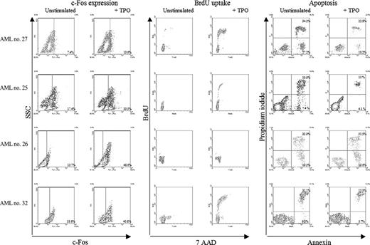Figure 4. c-fos expression, proliferation, and apoptosis in 4 representative patients. In 3 patients (first, second, and fourth lines), TPO (200 ng/mL) incubation induced c-fos expression, increased the percentage of cells in S phase, and decreased the number of apoptotic cells (annexin V+ cells). In one patient (third line), TPO-induced c-fos expression was not associated with increased proliferation or decreased apoptosis. Relative levels of the nuclear oncoprotein c-fos in blast cells exposed in vitro to 200 ng/mL TPO were determined using flow cytometry assay after labeling by anti-c-fos monoclonal rabbit antibody and secondary antibody goat anti-rabbit IgG-FITC. Negative controls consisted in secondary antibody labeling alone. As with the methodology used in cell immunophenotyping, a threshold line was determined for each patient on the negative control sample such that 99% of unstained cells were under this line. The subset of fluorescent cells over the threshold line was considered to represent cells expressing c-fos. The frequency of leukemia cells in S phase was determined by flow cytometry detection of incorporated BrdU after 36-hour culture, with or without TPO (200 ng/mL).