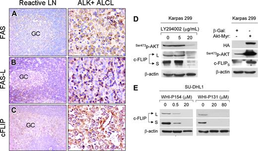 Figure 2. c-FL/P overexpression in ALCL. (A-C) Immunohistochemical detection of extrinsic apoptotic pathway proteins in reactive lymph node and ALK+ anaplastic large-cell lymphoma (ALCL) tumors. (A) CD95/FAS was weakly expressed in a subset of centroblasts within the germinal centers (GCs) of reactive lymph nodes (left). Strong cytoplasmic and membranous CD95/FAS expression was observed in most ALK+ ALCL tumors (right). (B) CD95L/FASL was strongly positive in the mantle and marginal zones of reactive lymph nodes (left). CD95L/FASL was not expressed in most ALK+ ALCL tumors (right). Infiltrating small reactive lymphocytes strongly expressed CD95L/FASL and served as internal positive controls in all tumor specimens. (C) c-FLIP expression was restricted to a subset of GC cells (left). Strong cytoplasmic expression for c-FLIP was observed in most ALK+ ALCL tumors (right). (D-E) c-FLIP up-regulation may result from activation of PI3K/Akt and JAK3/ALK oncogenic pathways. Immunohistochemistry: × 200 original magnification (20 ×/0.75 NA objective; left panels) or × 400 (40 ×/0.75 NA objective; right panels). Images were obtained with a BX51 Olympus microscope, a DP12 Olympus camera, and a universal semi-apochromat UPlan FI lens. (D, left panel) Karpas 299 and SU-DHL1 cells were treated with a PI3K inhibitor, LY294002, at concentrations of 0, 5, or 20 μg/μL. Whole-cell lysates were then prepared at 48 hours. Immunoblots showed that serine 473 phosphorylation of Akt is almost completely inhibited at a concentration of 20 μg/μL that is associated with a substantial decrease of c-FLIP levels. (D, right panel) Karpas 299 and SU-DHL1 cells were infected with the constitutively active, myrAkt adenovirus21 at an MOI of 20, which significantly increases Ser473pAKT levels in these cells. Expression of myrAkt was confirmed by Western blot analysis using a monoclonal antibody specific for the hemagglutinin (HA) tag. An adeno-β-Gal adenovirus construct expressing β-Gal served as a control in this experiment. Whole-cell lysates were prepared from control and infected cells 48 hours after infection. Immunoblots showed a dramatic increase of Akt phosphorylation, which was associated with an increase of c-FLIPS splice variant. (E) ALK+ ALCL cells were treated with 2 known JAK3 inhibitors, WHI-P131 and WHI-P154, at concentrations previously shown to inhibit JAK3 and ALK enzymatic activity. 25Whole-cell lysates were prepared 24 hours following treatment. Immunoblots demonstrate that c-FLIP levels are decreased after treatment with WHI-P131 or WHI-P154 in a dose-dependent manner.