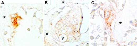 Figure 4. Immunohistochemistry for CCL-9 in the proximal tibia of tl rats. Immunohistochemistry after 2 (A), 4 (B), or 6 (C) days of CSF-1 injections is shown. Orange-brown color indicates CCL-9 protein. At day 2, the staining was most evident in small, newly formed osteoclasts, while at days 4 and 6, large, mature osteoclasts were present with much weaker, more diffuse labeling. *Bone trabeculae; v indicates a prominent vacuole in the large osteoclast in panel B. Scale bar in panel C equals 21 μm. Shown are 10-μm paraffin sections without counterstain. Objective magnification: 63 ×/1.25 NA.