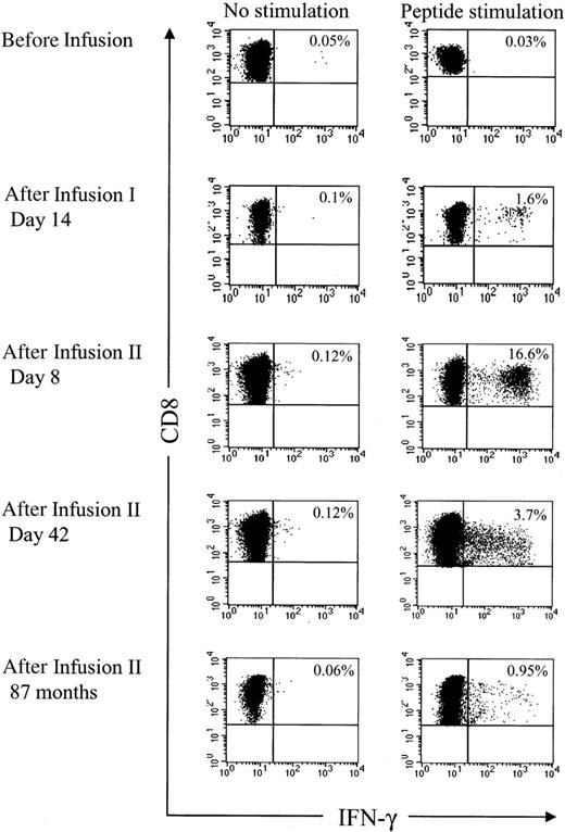 Figure 6. The HSV-TK–specific CD8+ T cells are boosted after reinfusion of HyTK-positive donor T cells. Samples of PBMCs were obtained from UPN 1574 before and at various time points after the first and second infusion of HyTK-modified donor T cells. Aliquots of these cells were incubated for 6 hours with medium alone or with all 6 candidate 15-mer peptides that were identified to induce IFN-γ production in samples of PBMCs obtained from this patient. After 6 hours of stimulation, cells were permeabilized, stained with anti–IFN-γ and anti-CD8 mAbs, and examined by flow cytometry. Values indicate the percentage of CD8+ T cells producing IFN-γ.