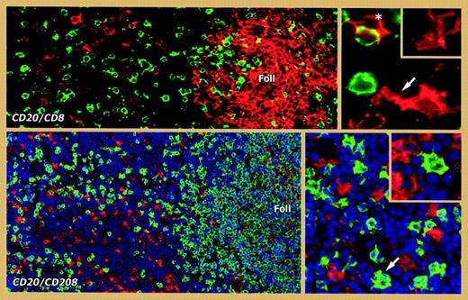 Double immunofluorescence labeling of lymphoid tissue to show interfollicular B cells. Top panel: The low-power view (left) shows B cells (labeled in red for CD20) and CD8+ T cells (green). Scattered B cells are present in the interfollicular area adjacent to a B cell follicle (Foll). The high-power view (right) shows dendritic processes extending from several of these interfollicular B cells (arrow) and a single example of an interfollicular B cell (asterisk) in intimate contact with a CD8 cell. Bottom panel: Double immunofluorescence labeling for CD20 (green) and the dendritic cell marker CD208/DC-LAMP (red) shows that these 2 cell populations are clearly distinct. In the high-power view (right), typical interfollicular dendritic B cells are seen (eg, in the inset and as indicated by an arrow). Adapted from Marfioti et al1 (used with permission).