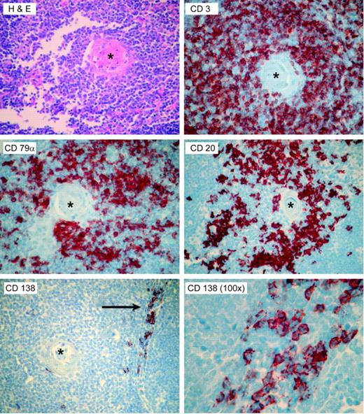 Figure 6. The presence of B cells and plasma cells in the normal human thymii. Ten pediatric thymii were stained by hematoxylin and eosin, and by immunohistochemistry for the T-cell-specific marker CD3, the pan-B-cell markers CD79α and CD20, and the plasma cell-specific marker CD138. Representative photomicrographs from a single thymus are shown. The CD20+ cells appeared to cluster around the Hassel corpuscles (asterisk), while the CD138-staining plasma cells were seen in the medullary areas (arrow). Micrographs are all × 40, except as noted.