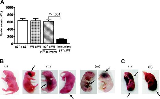 Figure 3. Spontaneous hemorrhage and thrombocytopenia in heterozygous progeny of immunized β3-/- mothers. (A) Thrombocytopenia in heterozygous pups delivered from immunized β3-/- mothers (transfused twice with WT platelets) crossed with WT males. Pups from breeding cages of WT × WT, β3-/- × β3-/-, and naive female β3-/- × WT were used as a control. Data are presented as means ± SEM; n = 7-25 for each group. (B) Spontaneous bleeding in heterozygous pups delivered from immunized β3-/- mothers. (i) A heterozygous pup delivered from a naive β3-/- mother crossed with a WT male as a healthy control. (ii) Bleeding in live pups. (iii) Dead pups with massive ICH or abdominal bleeding. Bleeding is indicated by arrows. (C) Massive ICH and/or abdominal bleeding was found in fetuses in β3-/- mice immunized with 4 weekly transfusions of WT platelets. (i) ICH and abdominal bleeding. (ii) ICH.